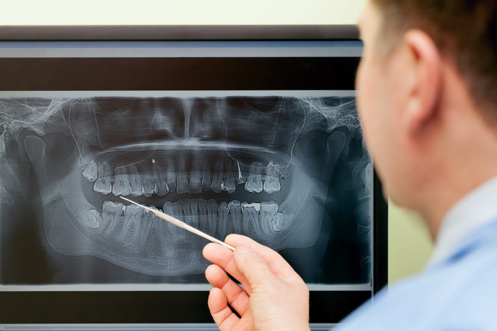 Wisdom Teeth Removal & Surgery in Kelowna | Dr. Sandy Crocker